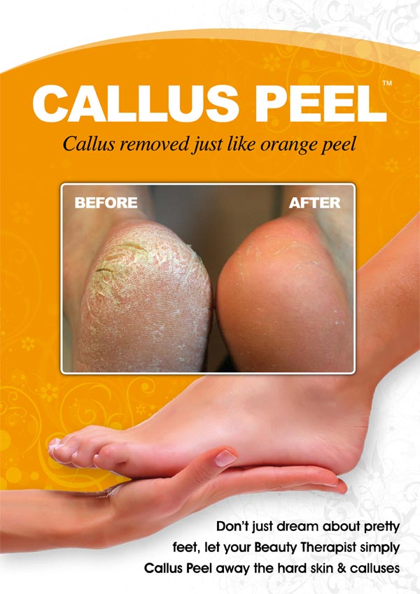 Callus-Peel-